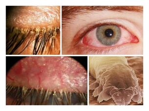 simptome ale prezenței paraziților sub pielea umană